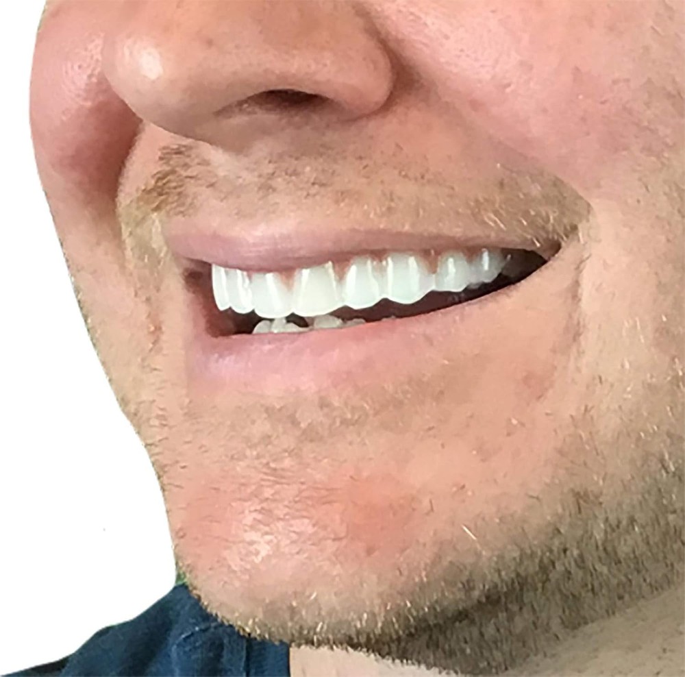 Flexible Upper Veneers for Natural Smile