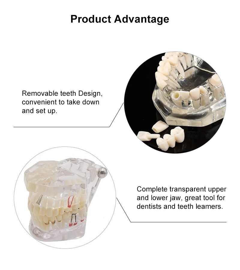 Dental Removable Restoration &Implant Pathological Disease Teeth Study Model