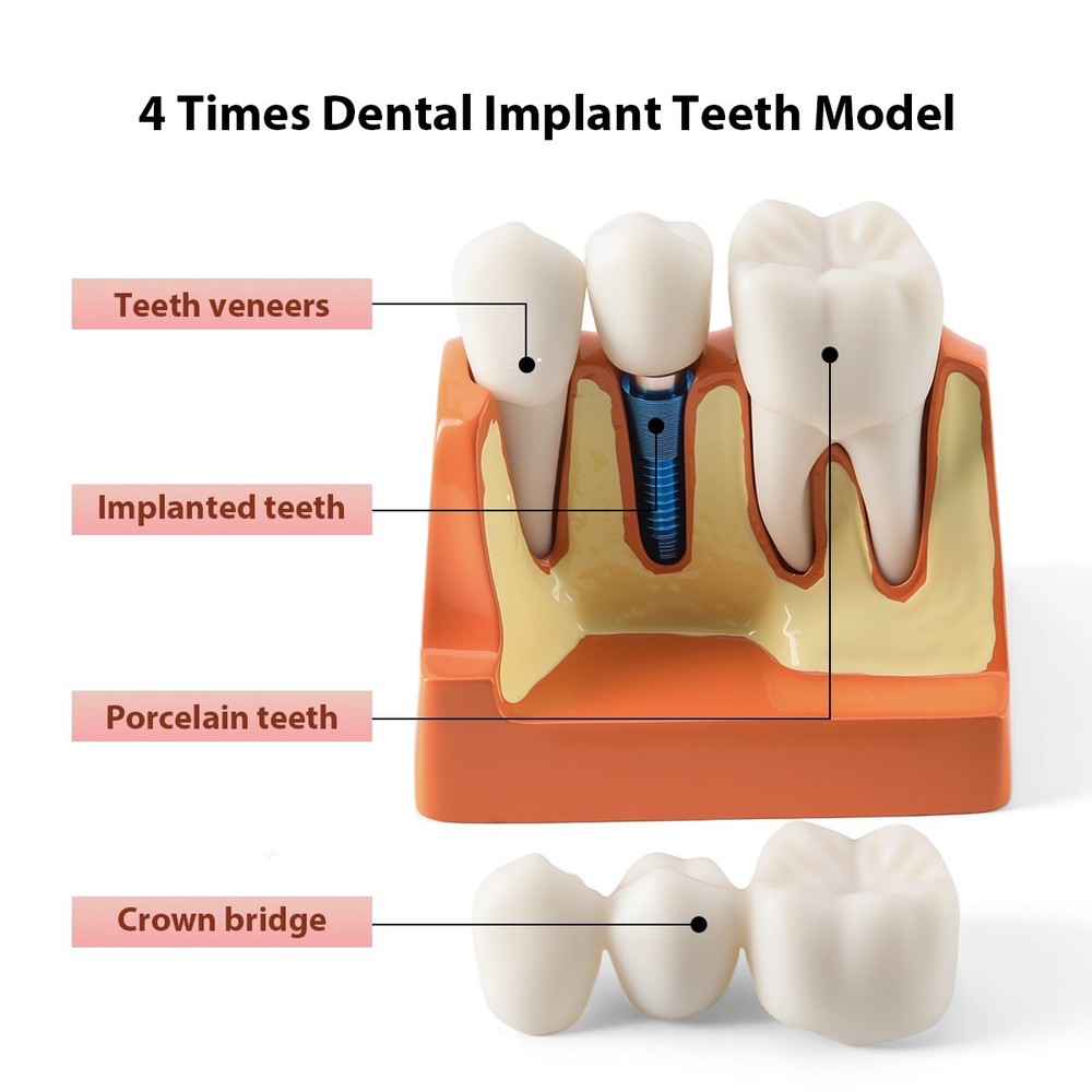 4 Times Dental Analysis Crown Bridge Demonstration Removable Teaching Model
