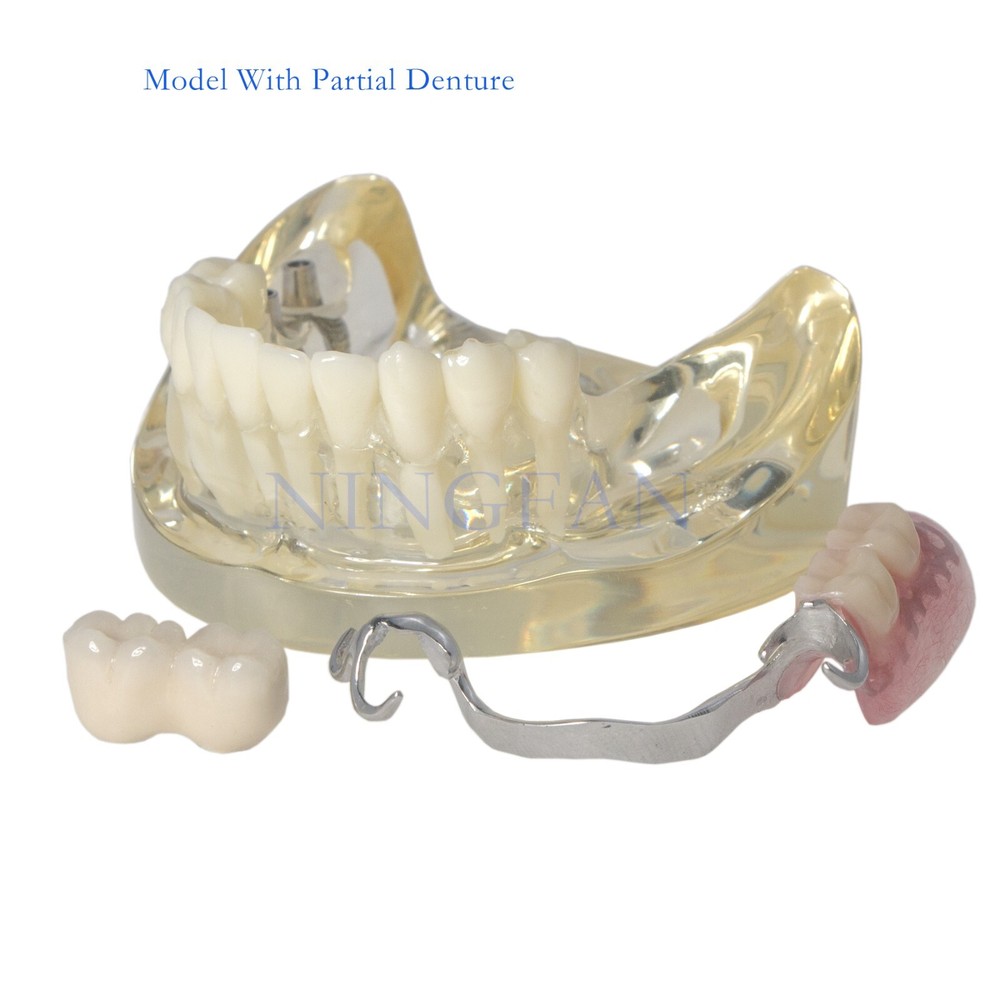 Dental Typodont partial denture Model RPD Demo Retainer WIth 2 Implants