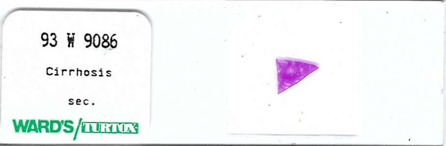 Cirrhosis Pathology Microscope Slide