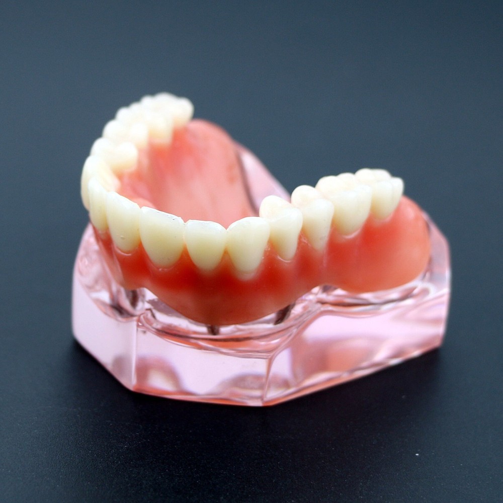Dental Implant Overdenture Upper Superior Model Precision 4 Maxillary