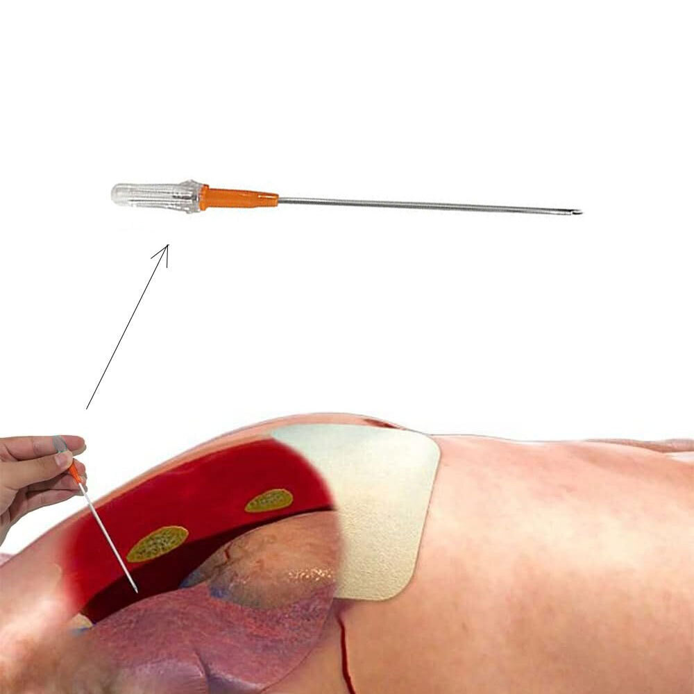 2pcs Rescue Tension Pneumothorax Needle Chest Decompression EDC First Aid 14G