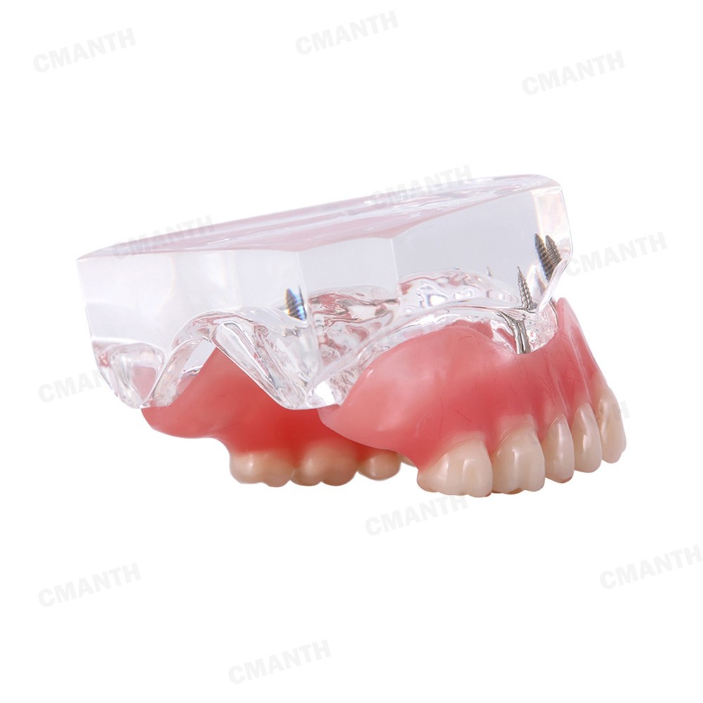 US Dental Model Removable Overdenture Teeth Upper/Lower Jaw 4 Implants Model