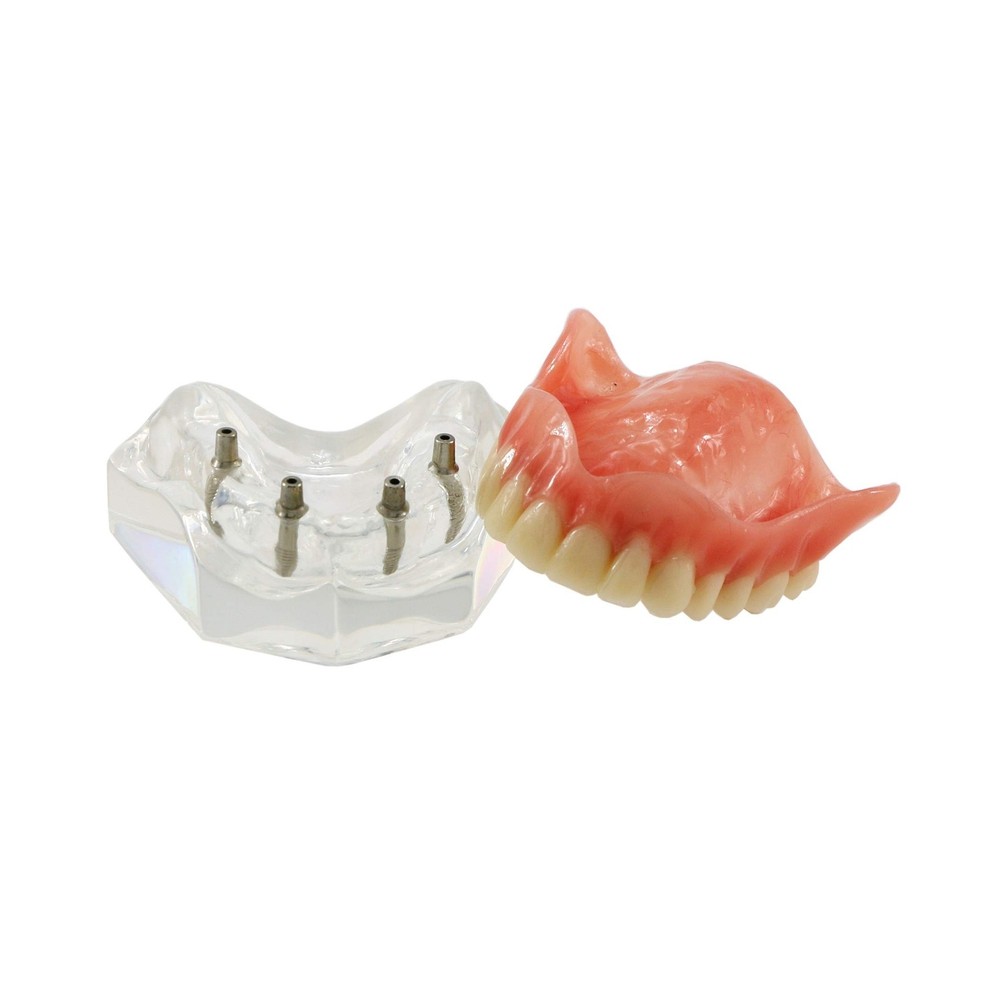 Dental Upper Implants Model Overdenture with 4 Superior Teeth Demo Transparen...
