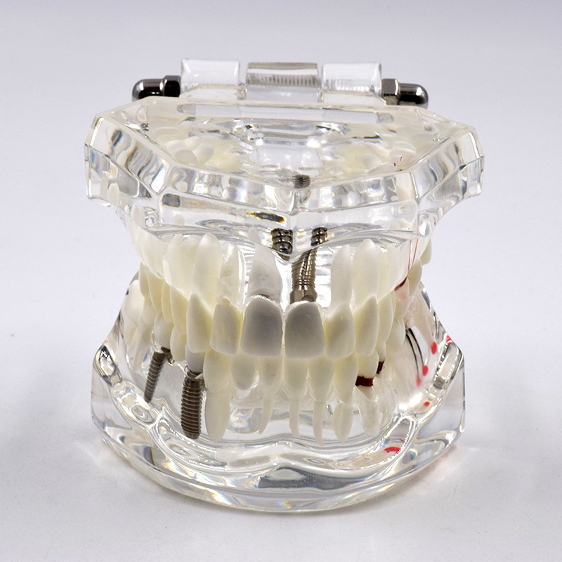 Dental Removable Restoration &Implant Pathological Disease Teeth Study Model