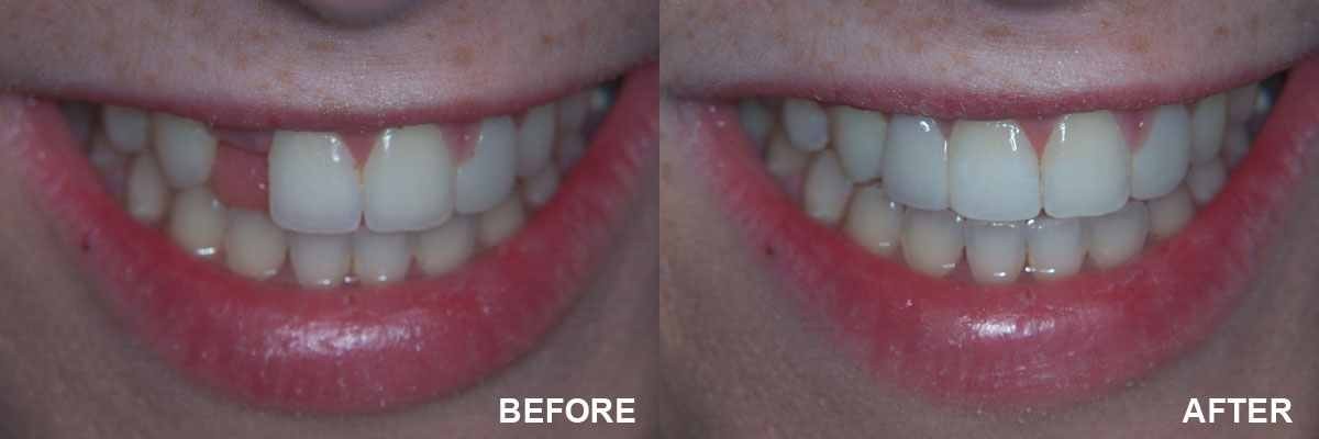 TEMPORARY TEETH TooTH REPAIR KIT * Cosmetic Repair * 30 teeth. IT REALLY WORKS!