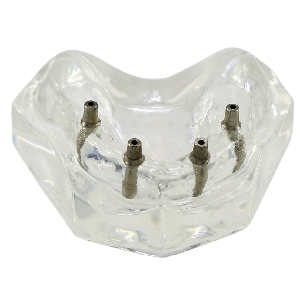Dental Typodont Implant Overdenture Teeth Model 4 Implants Upper Lower