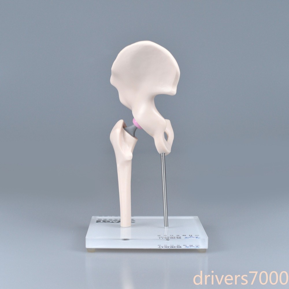 1/3 Artificial Hip Joint Replacement Anatomical Skeleton Demo Display Model