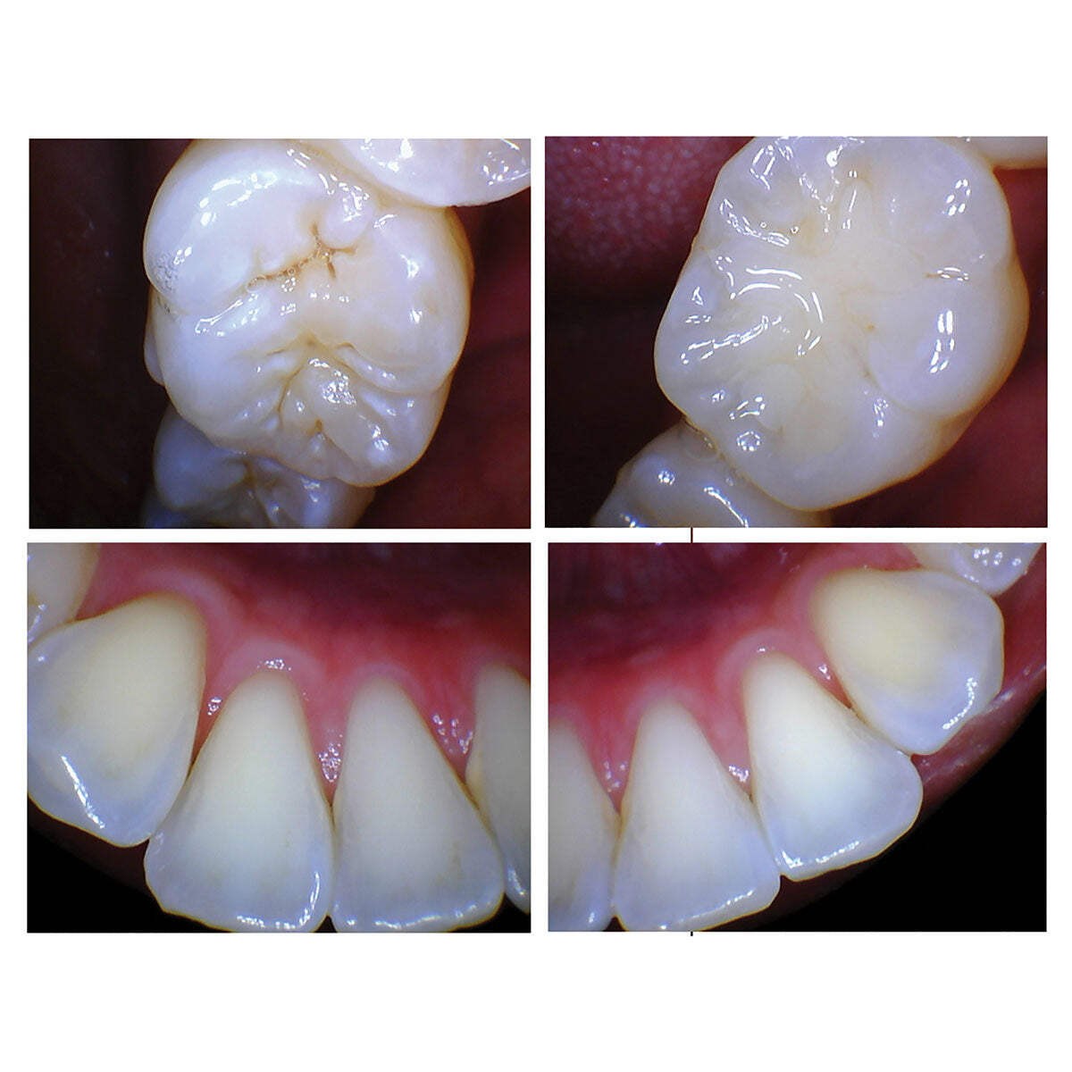 iCam LED Intraoral Camera