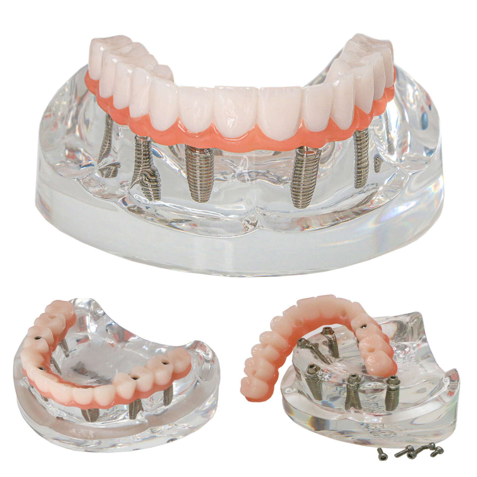 Dental All-On-6 Overdenture Implant Model Demo Upper Jaw 6 Screws Clear M6001-2