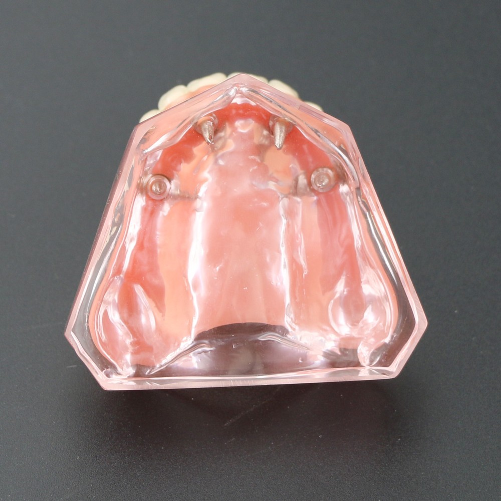 Dental Typodont Teeth Model Superior 4 Implants Overdenture Superior Demo Model