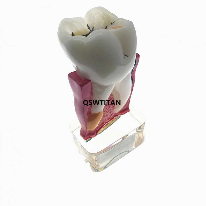 Teeth Model 4 times tooth pathology model Periodontal Teaching Study model