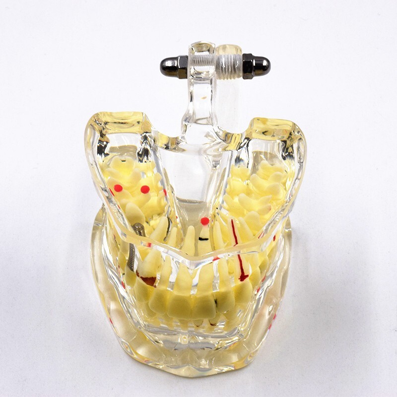 Dental Disease Teeth Model Pathological Transparent Adult Teaching Study 1 Pc