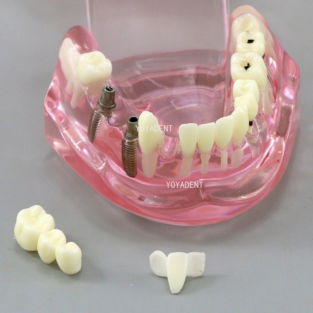 Multiple Types Dental Teaching Teeth Model Typodont Ortho Implant Practice Demo