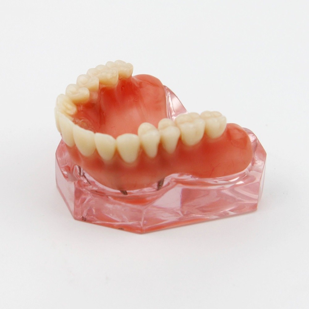 Dental Implant Teeth Model Demo Overdenture Restoration Teaching Study 4 Models