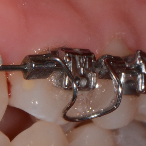 Dental Orthodontic Torquing Torque Spring Rectangular wire Single Anterior Teeth