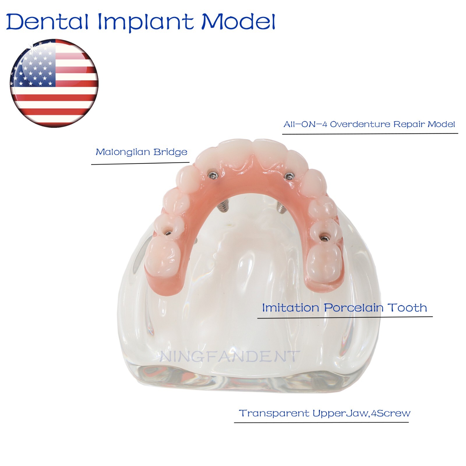 US Dental All-on-4 Overdenture treatment Implant Model Upper 4 Implants Clear