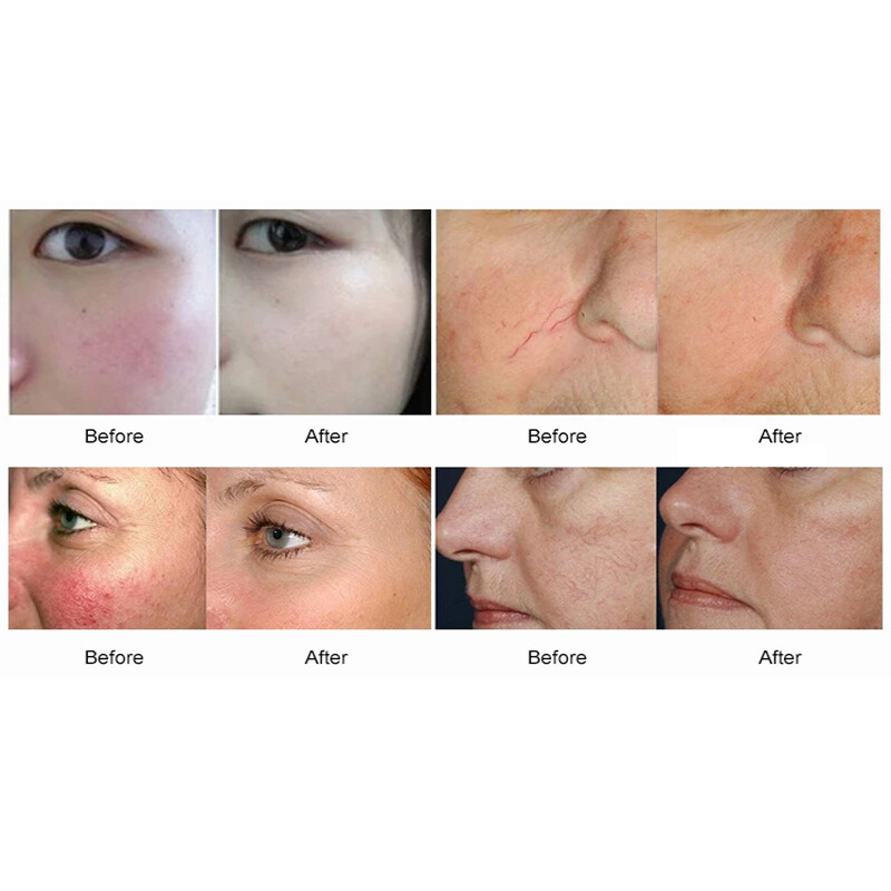 二极管激光 980 纳米血管血液去除蜘蛛静脉物理治疗机-