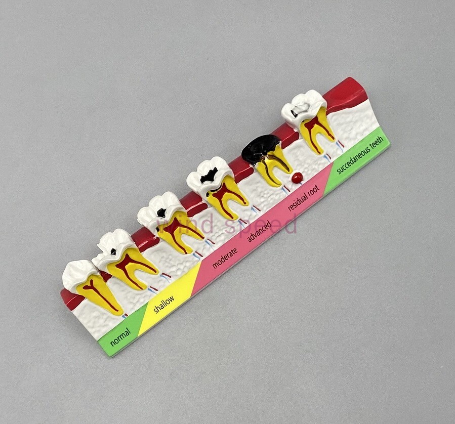 New Dental Study Teaching Models Caries Disease Assort Teeth Dentoform Model