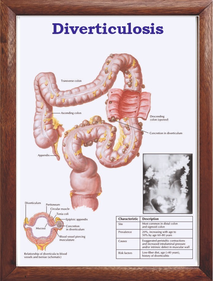 Diverticulosis Chart 12x18 inches