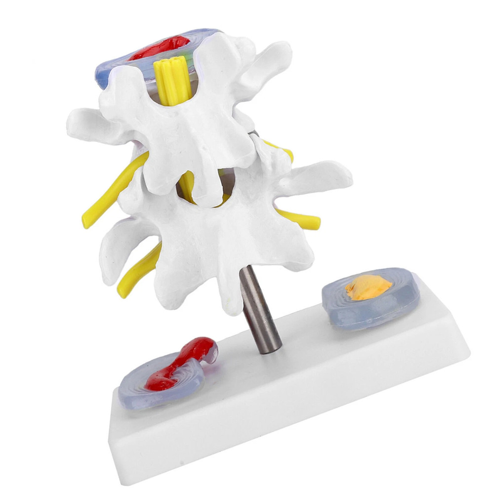 Anatomical Lumbar Disc Herniation Demonstration Model Human Spine School