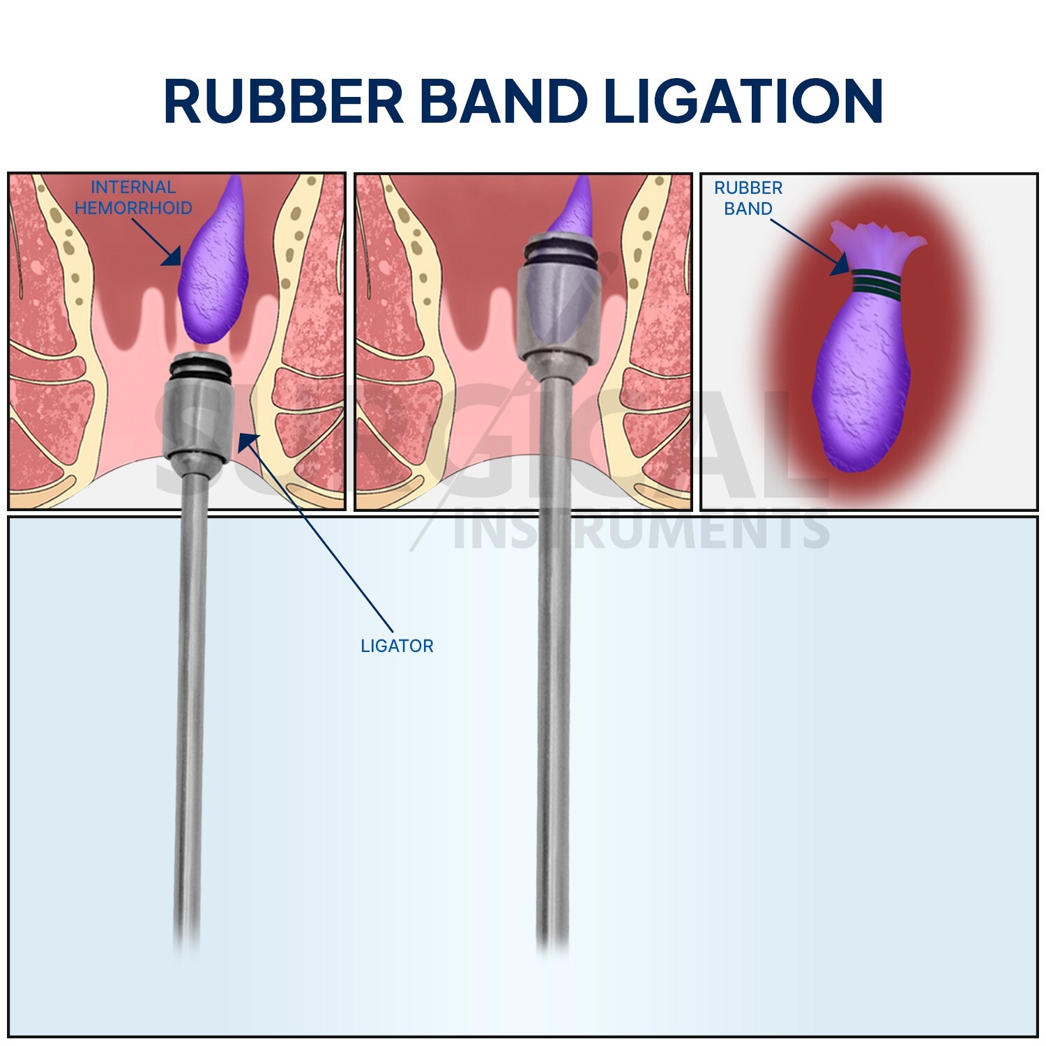 Hemorrhoid Suction Ligator Straight Angle & 100 Latex Bands Surgical Instruments