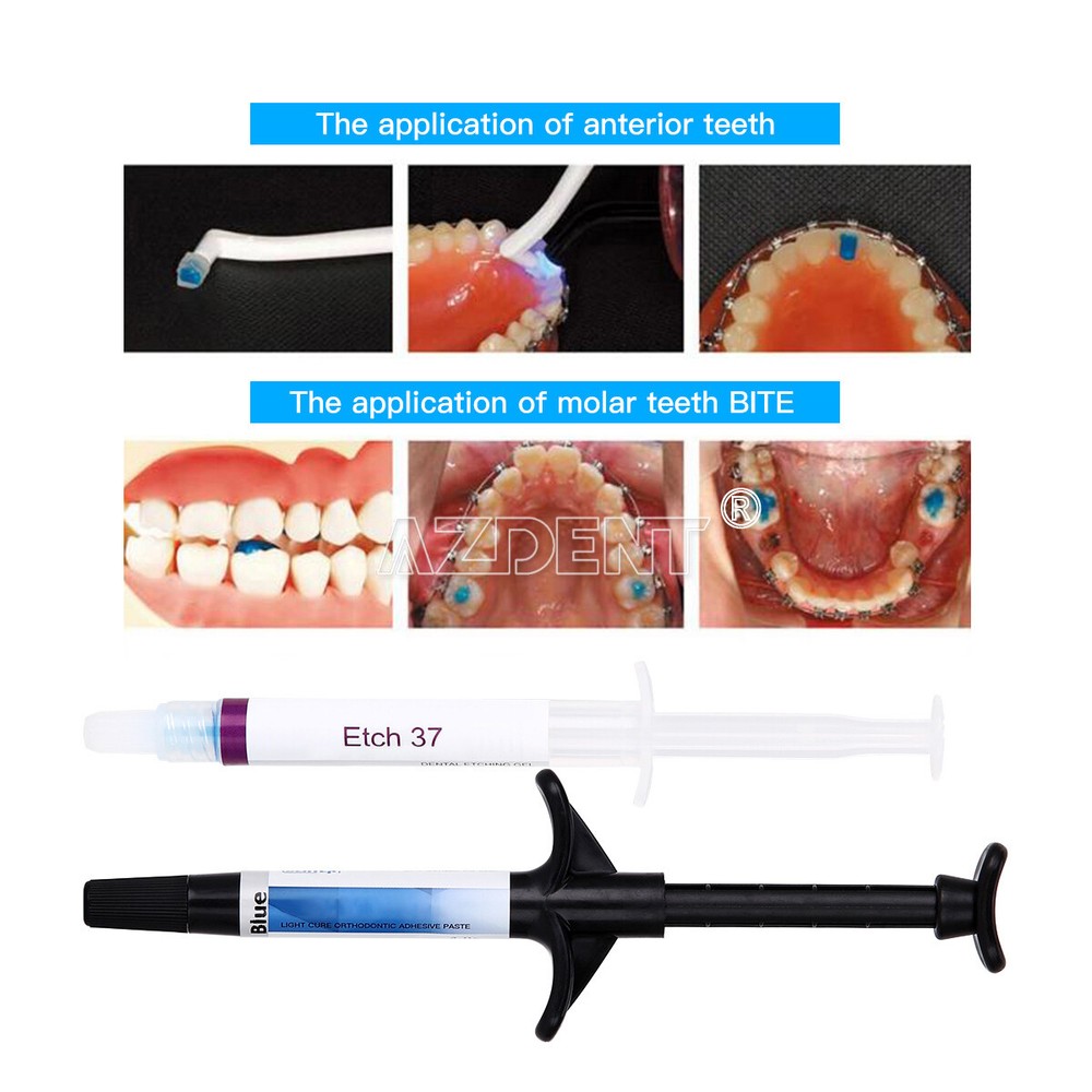 Dental Light Cure Orthodontic Braces Adhesive Paste Acid Etchant Kit Blue 5 Tips