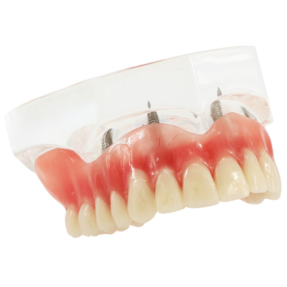 Dental Multi Typodont Teeth Model for Implant Pathological Restoration Practice