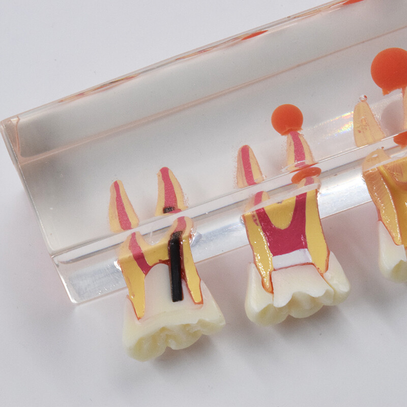 Dental Study Teaching Model Periodontal Caries Disease Teeth Dentoform Typodont