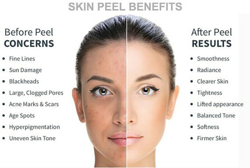 Lactic Acid Skin Peel For Acne Wrinkles Melasma Age Spots 25% 40% 50% 90%
