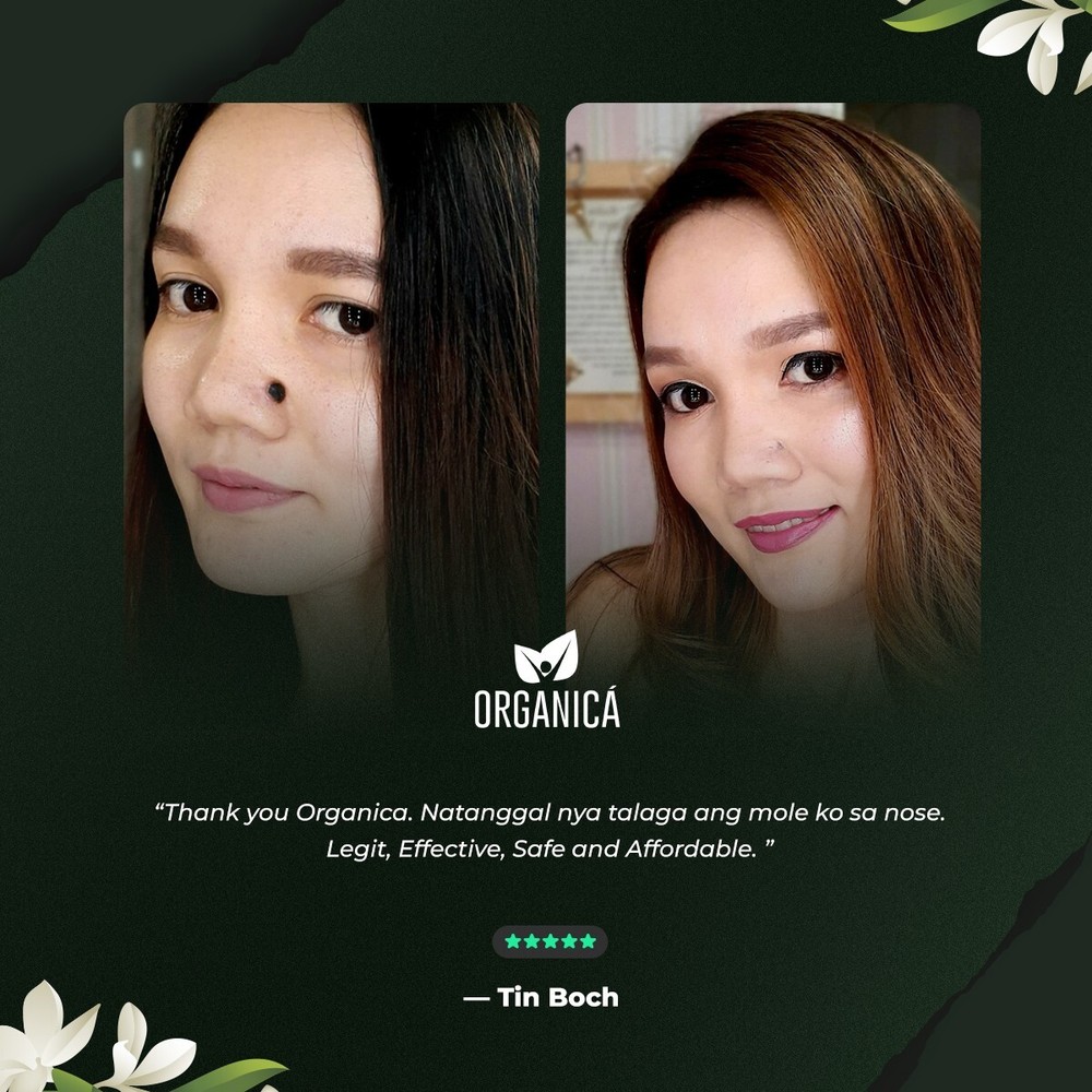 Multi-Awarded Mole and Warts Remover Set