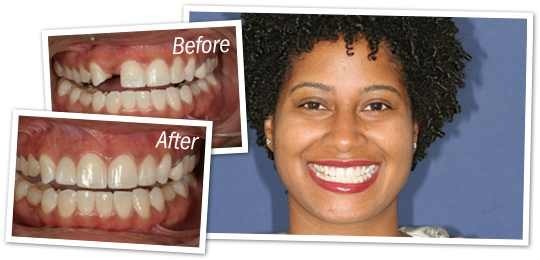 TEMPORARY TEETH TooTH REPAIR KIT * Cosmetic Repair * 30 teeth. IT REALLY WORKS!