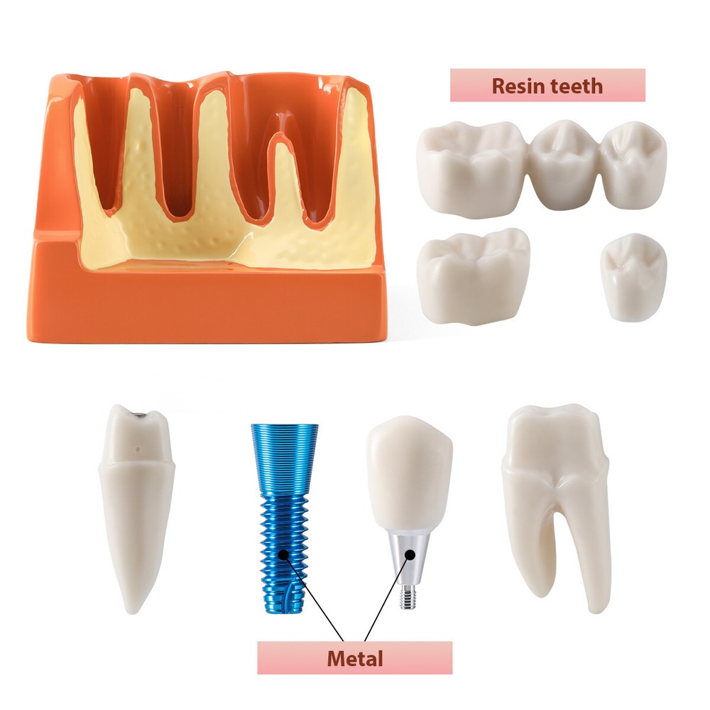 Dental 4Times Teeth Model Implant Analysis Crown Bridge Removable Study Training