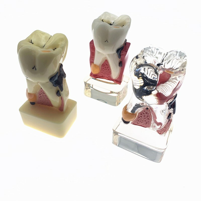 Teeth Model 4 times tooth pathology model  Periodontal Teaching Study model