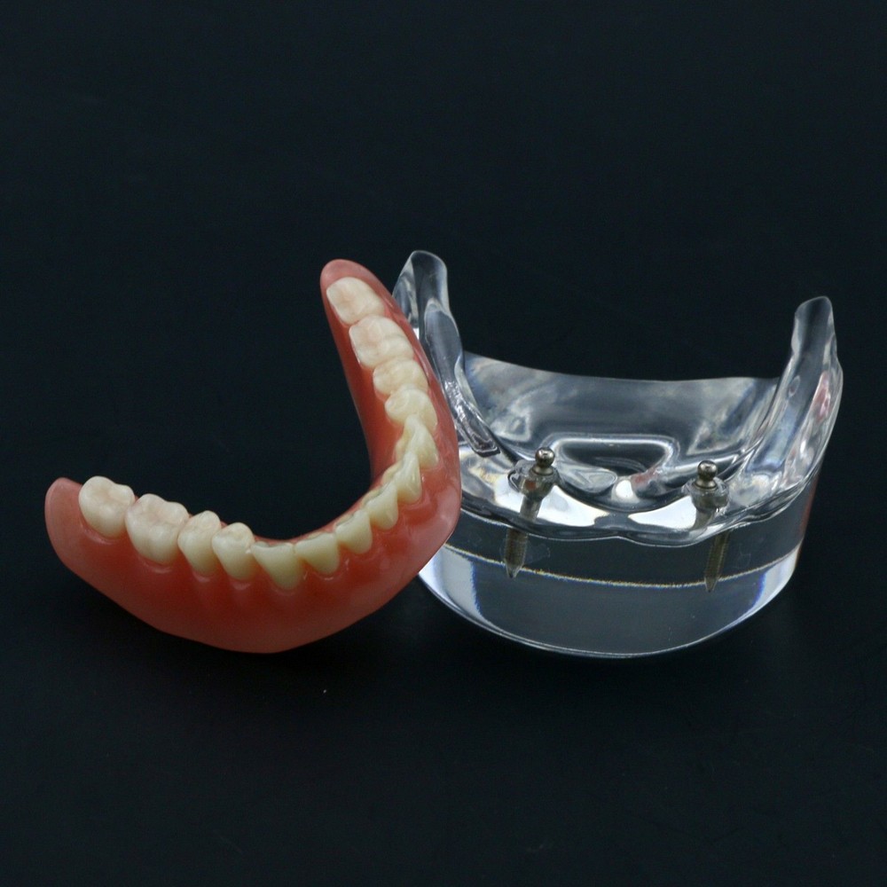 Dental Oral Transparent Upper Teeth 2/4 Implants Model Overdenture Restoration