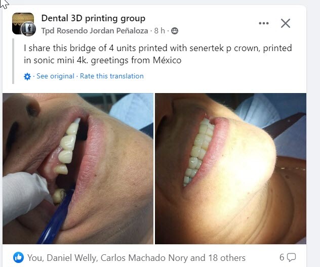 DLP SLA LCD 3d printer permenant crown - teeth resin ..