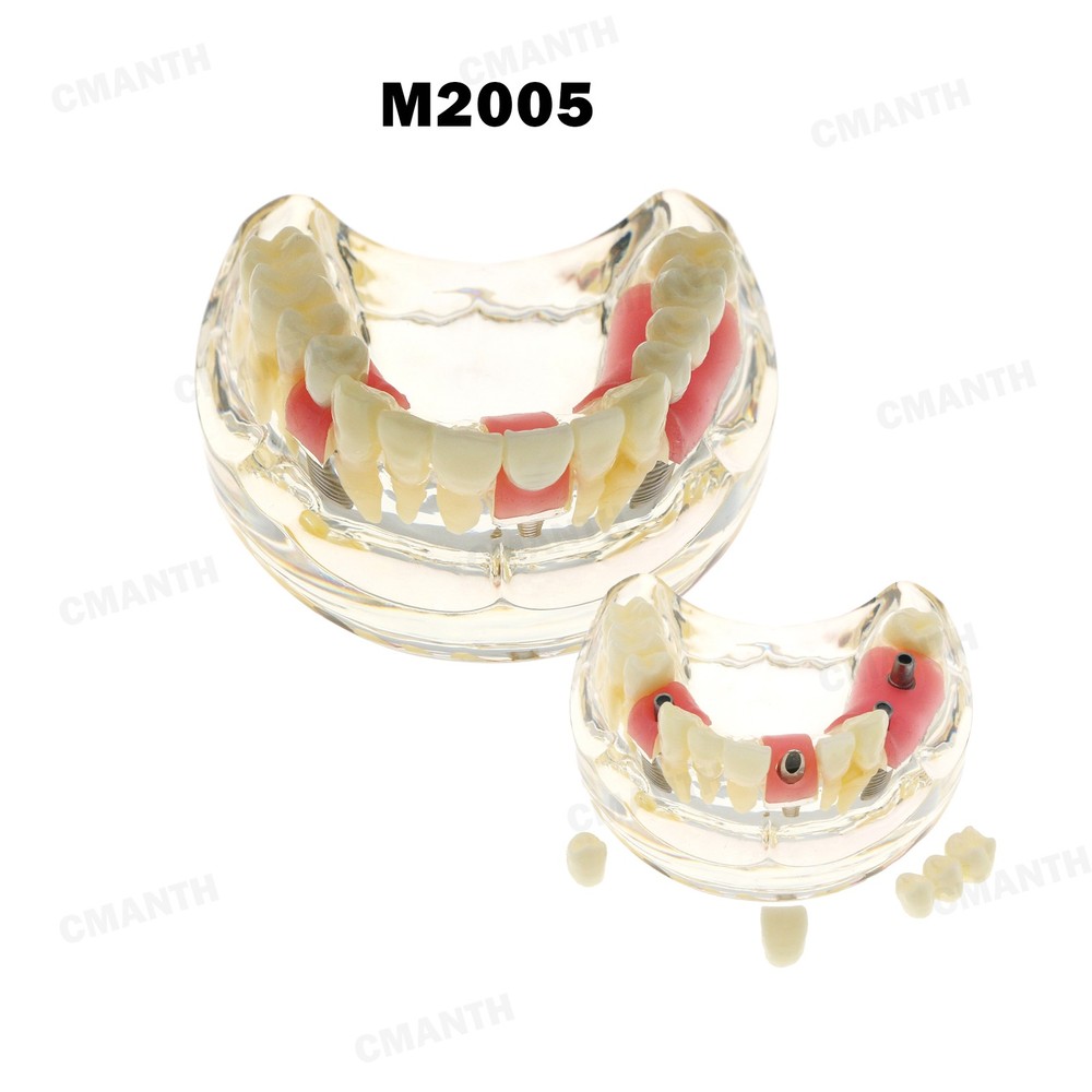 Dental Teeth Pathological Perio Practice Implant Model Studying Teaching M2005