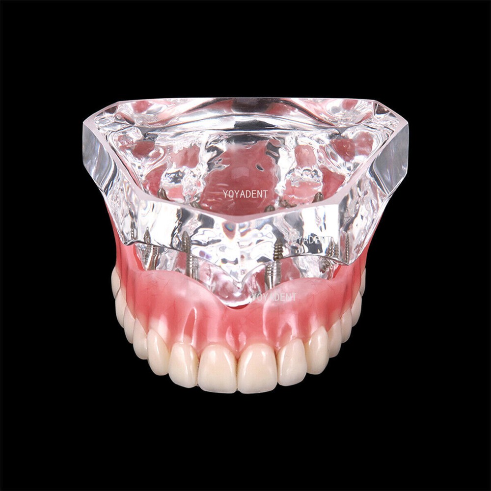 Dental Teeth Model Removable Overdenture Teeth Upper/Lower Jaw 4 Implants Model