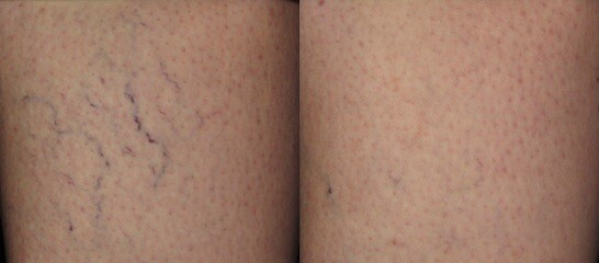 Philaser for Spider Veins