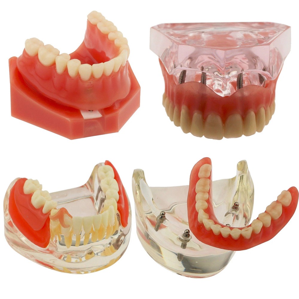 7 Types Dental Overdenture Restoration Model Implants Typodont Teaching Study
