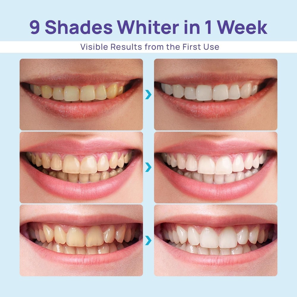Whitebite Pro Teeth Whitening Kit for Sensitive Teeth – Dual LED Light + 35% Car