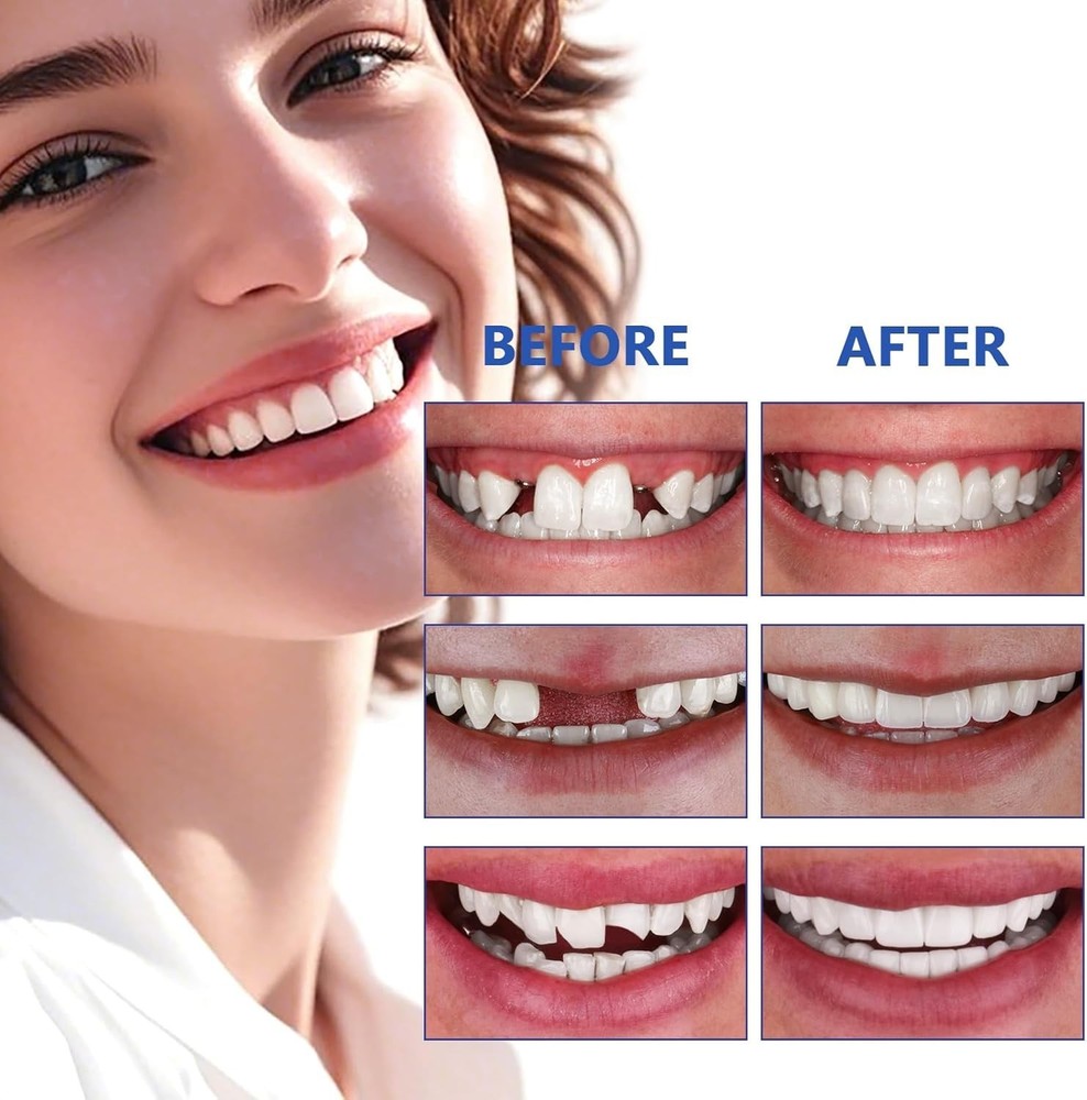 Teeth, Tooth Replacement Missing Teeth, Teeth Filling Kit Permanent with Tool,