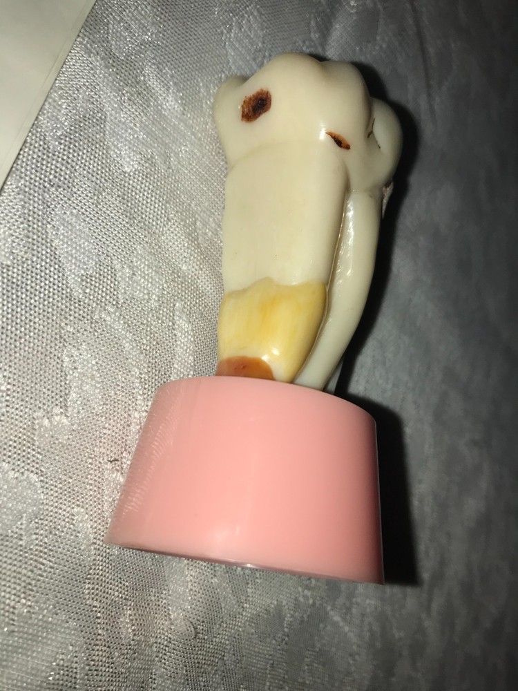 RARE Vintage DENSCO #40 Master Visual Aid TOOTH Dentist CAVITY Learning 3D MODEL