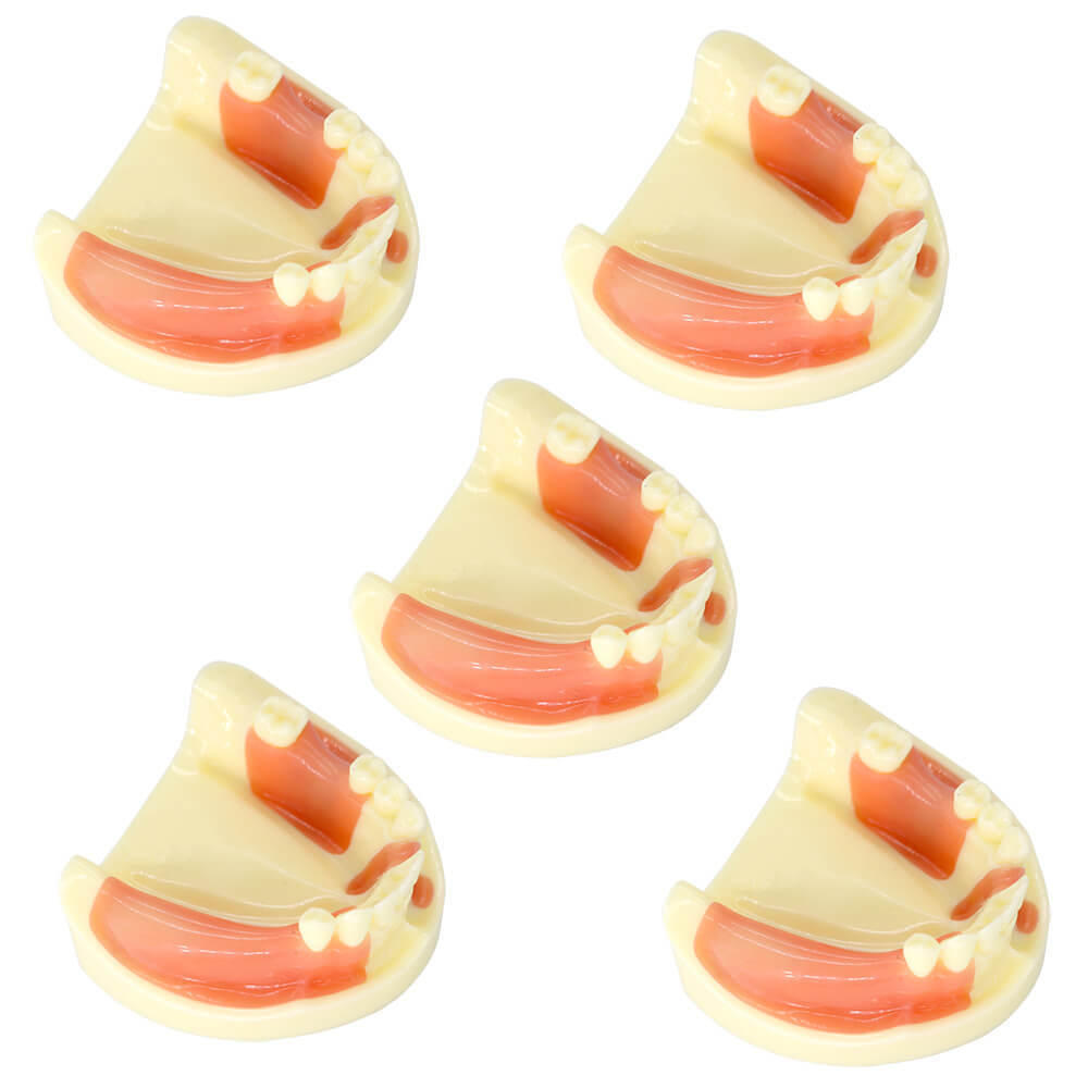 Dental Implant Training Model with Missing Teeth & Bone Loss Simulation