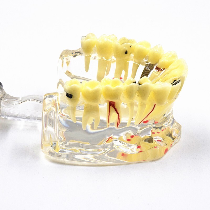 Dental Disease Teeth Model Pathological Transparent Adult Teaching Study 1 Pc