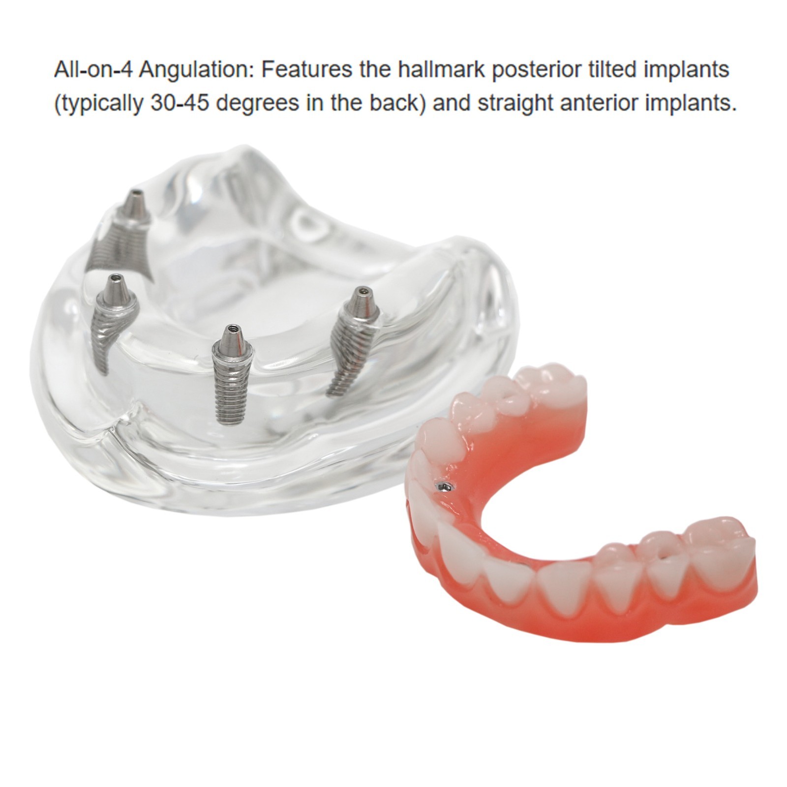 Implant Overdenture Al-on-4 treatment concept Demo Teeth Model Upper/4Srew Clear
