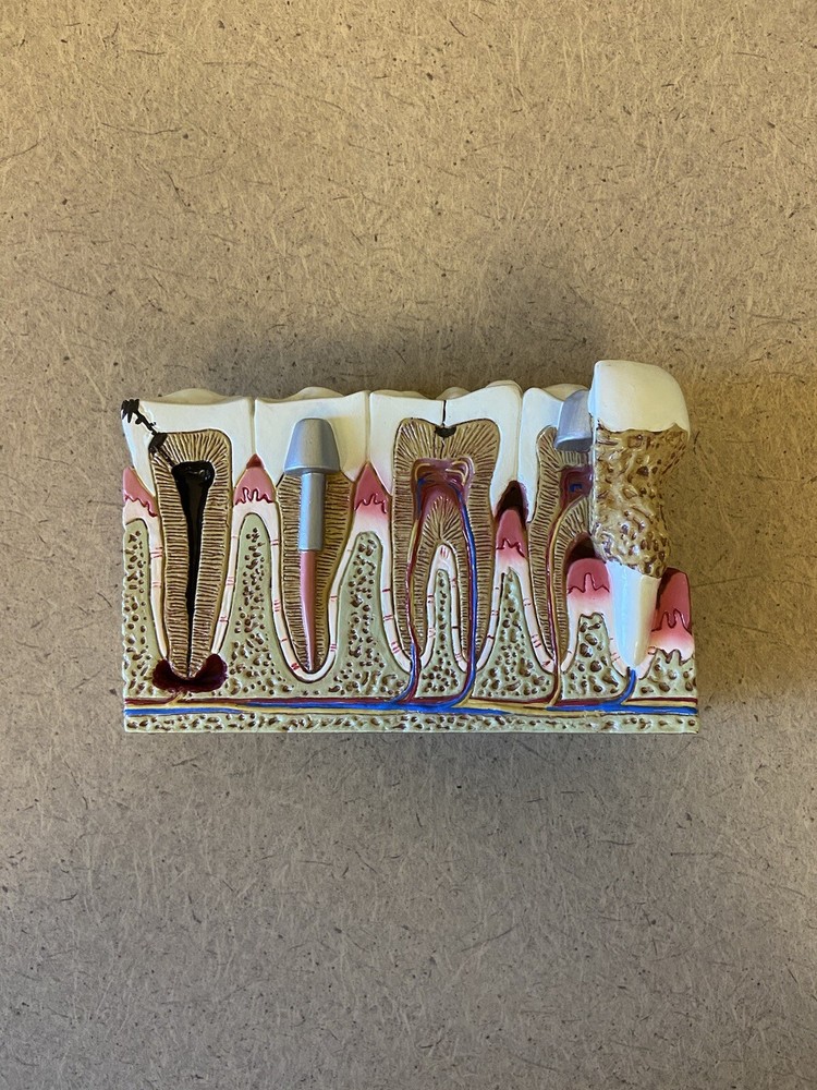 GPI Anatomicals Diseased Teeth & Gums Model