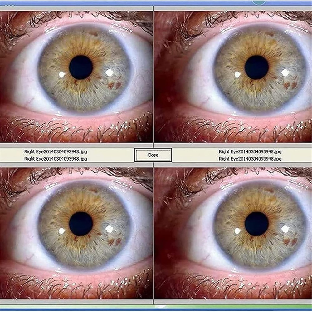 Analyzer Camera HD Iriscope Eye Camera with Analysis Software for Detailed Eye