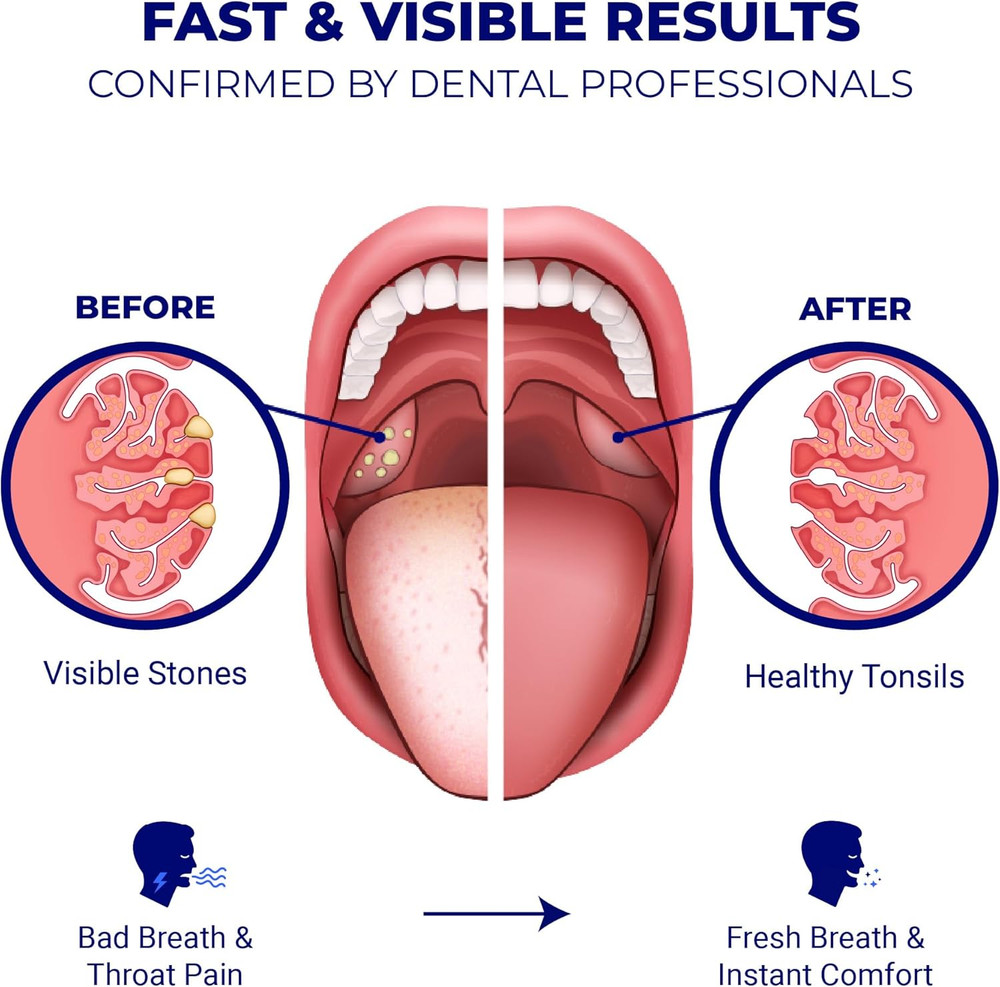 Tonsil Stone Remover - Tonsil Stone Removal Kit - Tonsillolith Remover Tool